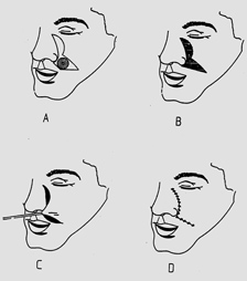 Docteur Nicolas VIDAL. Chirurgie maxillofaciale et esthétique du visage à la Réunion 974. Les lésions du nez.